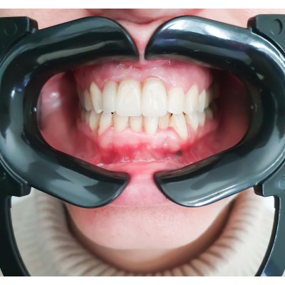 Set of 2 black mouth openers "C Shape" 2 pcs - MOUTH OPENER FOR PHOTOGRAPHY