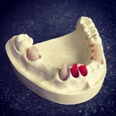 Pattern eXpress® - CASINABLE RESIN