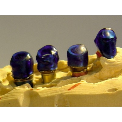 Lumix Blue Gel 3 syringes of 3 gr - LIGHT-CURING GEL, CASTABLE