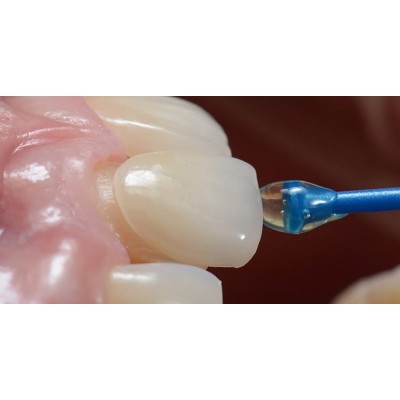 Take Stick - ADHESIVE APPLICATOR FOR VENEERS / CROWNS / INLAYS