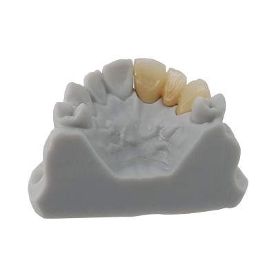 BIOK-3D C&B A2 for Castable Temporaries - 3D PRINTING RESIN FOR TEMPORARIES (Castable)