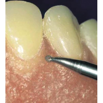 Gingiva bur