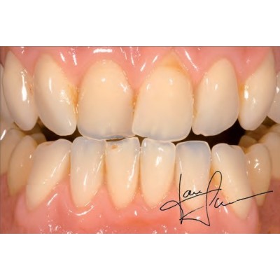 Gebdi Tribos 501 Lower Anterior - 3-ply pmma teeth